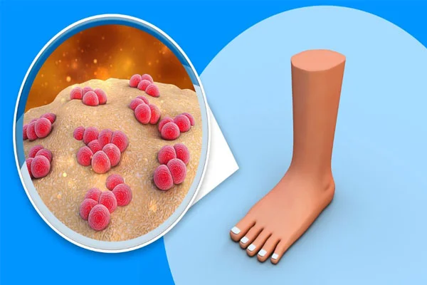 Şekerin Ayağa Vurması 